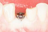     "Neodent", "Dentis Implant", "MEGA'GEN", "Bio3 Implants", "K3Pro konus dental implants" ( )